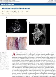 St segment / t wave ratio: Effusive Constrictive Pericarditis Journal Of The American College Of Cardiology