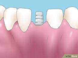 Periodontal disease results from plaque deposition on the teeth due to incorrect flossing and a significant procedure used by dentists to reverse dental bone loss is bone replacement through grafting techniques. 3 Ways To Reverse Dental Bone Loss Wikihow