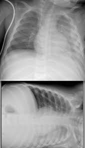 Heart failure, pneumonia) or a chronic condition already known to some patients with fibrous or loculated effusions may also require intrapleural fibrinolytic therapy (e.g. Loculated Pleural Effusion Lateral Decubitus Pleural Effusion X Ray Findings The American Thoracic Society Delineates Three Progressive Kenneth Erhardt