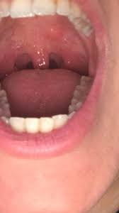 Da due settimane soffro di mal di gola