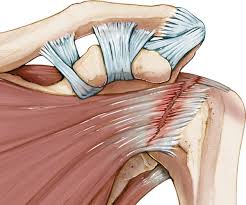 Image result for Rotator Cuff Rupture