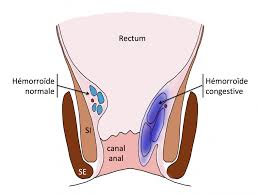 El tratamiento para las hemorroides con bandas elásticas y la cirugía con el método thd, son las opciones adecuadas para tratar la enfermedad cuando está en grado 2 y 3. Traitement Des Hemorroides A Lyon Centre De Chirurgie Digestive