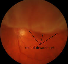 13,832 files in 1,208 albums and 49 categories with 72 comments viewed 3,090,757 times Retinal Detachment Eye Doctor In Elmhurst Il