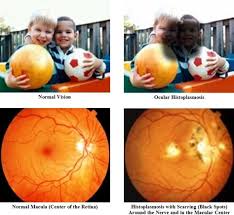 25 Best Ocular Histoplasmosis Images Diseases Of The Eye