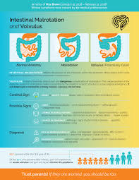 Image result for Intestinal Malrotation