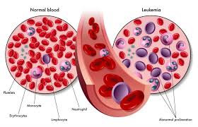 Check spelling or type a new query. Anemia Y Leucemia Causas Sintomas Diferencias Y Mas