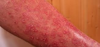 Schuppenflechte Psoriasis Ursachen Beschwerden Diagnose Behandlung Prognose Vorbeugung Gesundmed Medizin Und Gesundheit Im Web