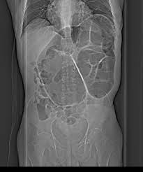 Sigmoid Volvulus Coffee Bean Sign In Elderly Prenatal Development Radiology Sigmoid Colon