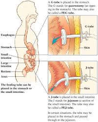 G Tube J Tube Peg These Always Confused Me Wish I Had This During Block I Nurse Nursing School Survival Nursing Notes