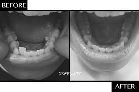 An Affordable At Home Solution To Straighten Teeth Diy Teeth Straightening Teeth Straightening Straight Teeth