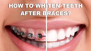 You'll have your braces on for a while. How To Get White Teeth With Braces 5 Ways To Keep Your Teeth Whiter