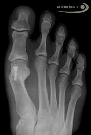 تورم إبهام القدم اجراحة التورم الطفيف تصحح وضع إبهام القدم Orthopaedic Doctor Germany Com