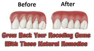 However, the likes of clove oil, aloe vera, sesame oil, coconut oil, lemon oil and olive oil may help a little with any pain on the soft tissue, they don't really work in the long term. Eating Disorders Gum Healing Grow Back Your Receding Gums With The Help Of These Natural Remedies Islam And Eating Disorders