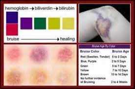 Image Result For Bruising Color Chart Bruises Makeup