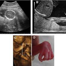 Prenatal Ultrasound Findings A Choroid Plexus Cysts At 18 Weeks Of Download Scientific Diagram