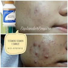 Dalam masa yang sama, sistem imun bertambah kuat terhadap demam, batuk dan selsema. Testimoni Vitamin C Untuk Jerawat Ziana Eunos