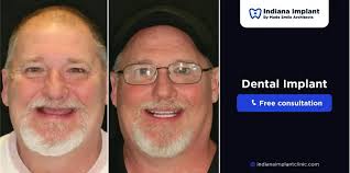 Understanding Dental Implant Rejection: Causes, Symptoms, and Prevention