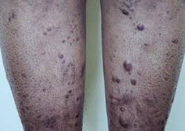 Scielo Brasil Leprosy Review Of The Epidemiological Clinical And Etiopathogenic Aspects Part 1 Leprosy Review Of The Epidemiological Clinical And Etiopathogenic Aspects Part 1