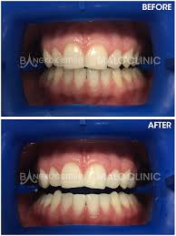 Does philips zoom whitening hurt? Zoom Whitening Bangkok Dental Dentist Clinic By Bangkok Smile Dental Clinic In Thailand