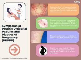 Image result for pruritic urticarial papules and plaques of pregnancy