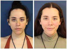 🥇 NYC Facial Feminization Before and After Pictures | Upper East Side
