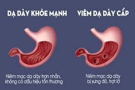 These jaws are locked in place by an internal mechanism, and can snap shut on prey or objects when sensory hairs on the inside of the mandibles are touched. Viem Loet Dáº¡ Day Cáº¥p Tinh Va Nhá»¯ng Dáº¥u Hiá»‡u Cáº§n Chu Y