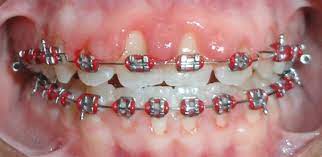 In its early stage, gums may become swollen, red and bleed. Swollen Gums And Braces Are They Related Dr Kyle Fagala
