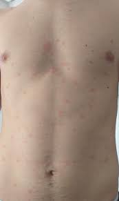 Welche symptome löst das coronavirus aus? Covid 19 Die Haut Schlagt Alarm Mdr De