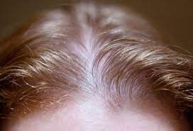 About 55 percent of women experience some hair loss by the age of 70. Women S Hair Loss Causes Treatments And Solutions