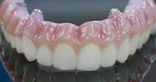 Pin On Implant Dentistry