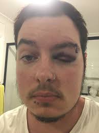 Fainting from low blood sugar and no breakfast