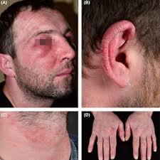 Patient #12. A 35-year-old aromatherapist had some itching scaling...