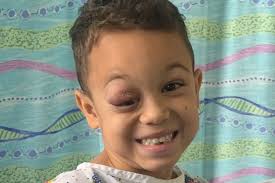 I was told my son's sore eye was just hay fever