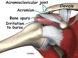 Maybe you would like to learn more about one of these? Impingement Syndrome Eorthopod Com