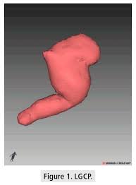Thank you for your response, ct volumetry may change by intragastric pressure,. Role Of Ct Volumetry Following Gastric Plication Surgery In Morbid Obesity Initial Experience In Correlating Postoperative Gastric Pouch Volume With Clinical Weight Loss