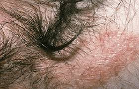 About half of those who have psoriasis also have scalp. Psoriasis Signs And Symptoms