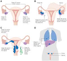 Nutrition for ovarian cancer patients: Cancers Free Full Text Kinase Inhibitors And Ovarian Cancer