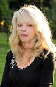 Straciła twarz, ale nie szansę na miłość