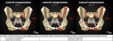 Image result for Pelvic Compression Test