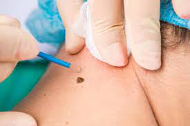 If you aren't sure which type of skin cancer. Skin Cancer And Mole Removal Irfan Khan Plastic Surgery