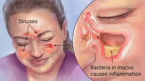 Image result for sinusitis