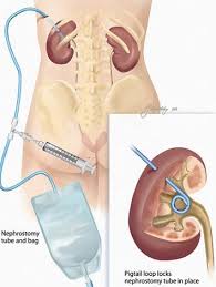 Urine Drainage Bag Google Search Kidney Surgery Kidney Failure Treatment Renal Transplant
