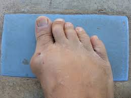 The doses that you use are going to depend on the purposes you are using the oil for and this does require a certain level of. Can Cannabis Effectively Treat The Symptoms Of Gout