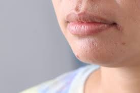 Image result for Angular Stomatitis