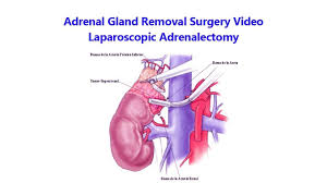 Adrenal Gland Removal Surgery Video Laparoscopic Adrenalectomy Removal Surgery Adrenal Glands Gland
