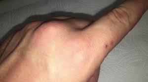 Image result for spinne biss haut reaktion