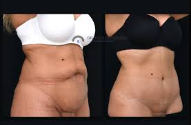 Fotos antes y después Abdominoplastia Madrid | Doctor Díaz Gutiérrez