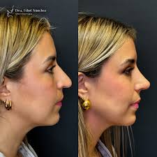 Experimenta la seguridad y la felicidad que una rinoplastia puede ofrecer!  ✨ 👩🏻‍⚕️ Dra. Ethel Sánchez