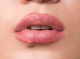Wer sich krank fühlt, schnieft und hustet, sagt häufig: Hausmittel Gegen Herpes Was Hilft Wirklich Wunderweib