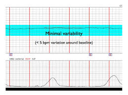 Qcom Fetal Heart Monitoring Baseline Variability